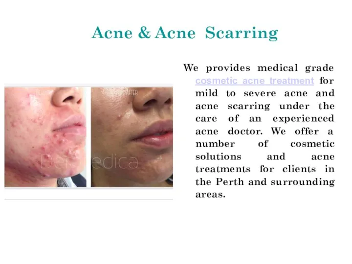 Acne & Acne Scarring We provides medical grade cosmetic acne treatment for