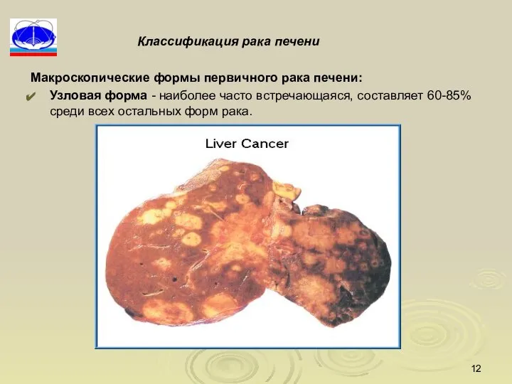 Классификация рака печени Макроскопические формы первичного рака печени: Узловая форма - наиболее