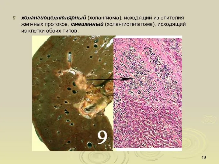 холангиоцеллюлярный (холангиома), исходящий из эпителия желчных протоков, смешанный (холангиогепатома), исходящий из клетки обоих типов.