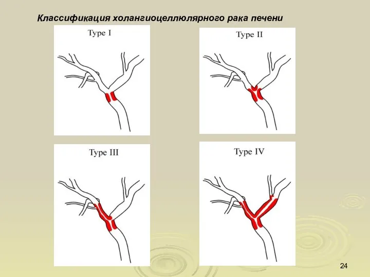 Классификация холангиоцеллюлярного рака печени