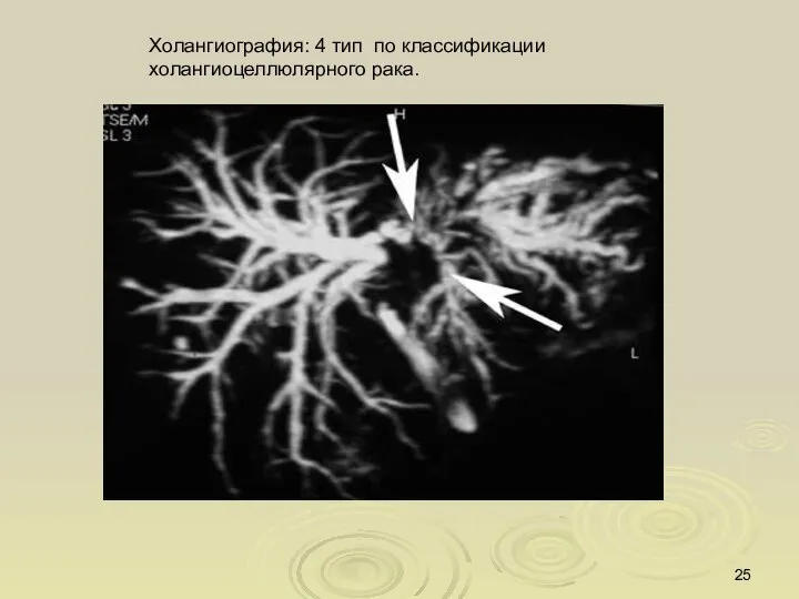 Холангиография: 4 тип по классификации холангиоцеллюлярного рака.