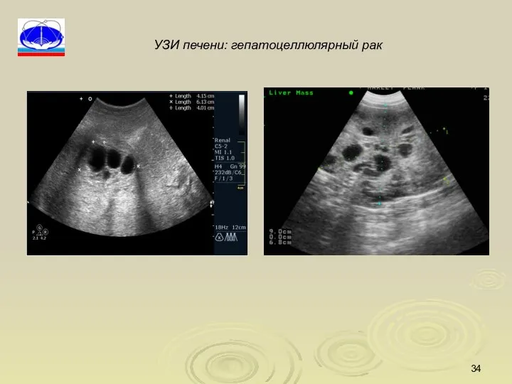 УЗИ печени: гепатоцеллюлярный рак