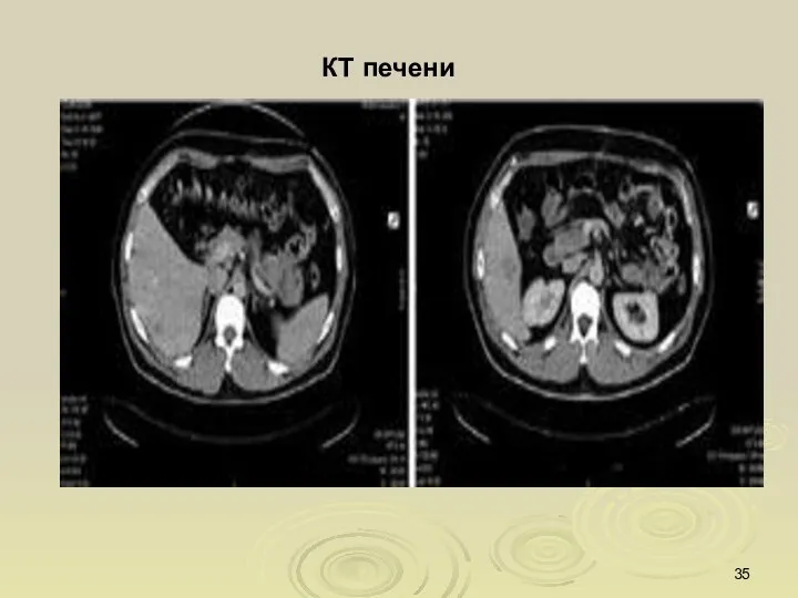 КТ печени