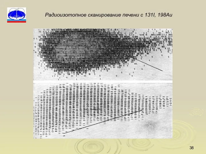 Радиоизотопное сканирование печени с 131I, 198Au