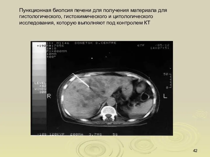 Пункционная биопсия печени для получения материала для гистологического, гистохимического и цитологического исследования,