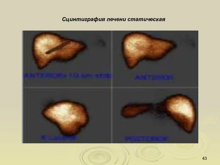 Сцинтиграфия печени статическая