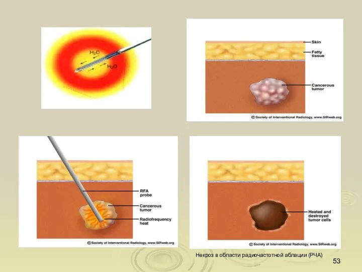 Некроз в области радиочастотной аблации (РЧА)‏
