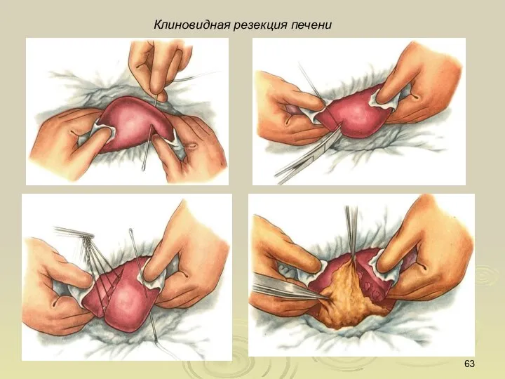 Клиновидная резекция печени