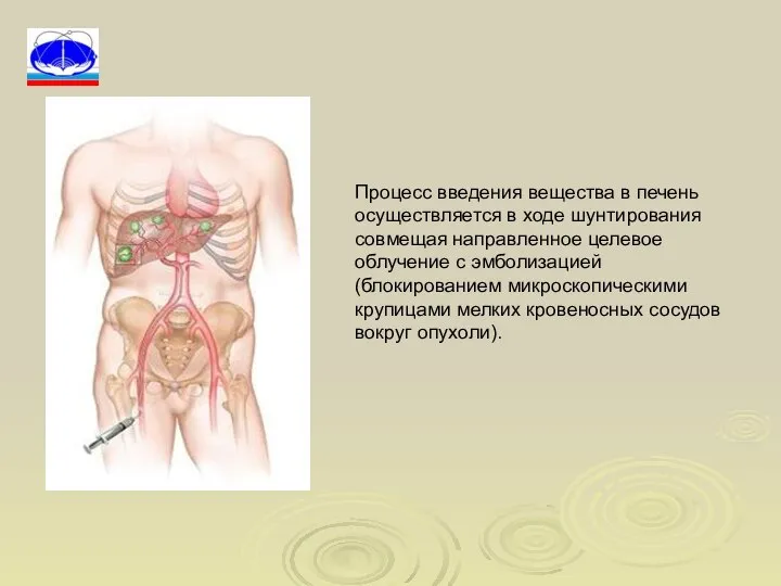 Процесс введения вещества в печень осуществляется в ходе шунтирования совмещая направленное целевое