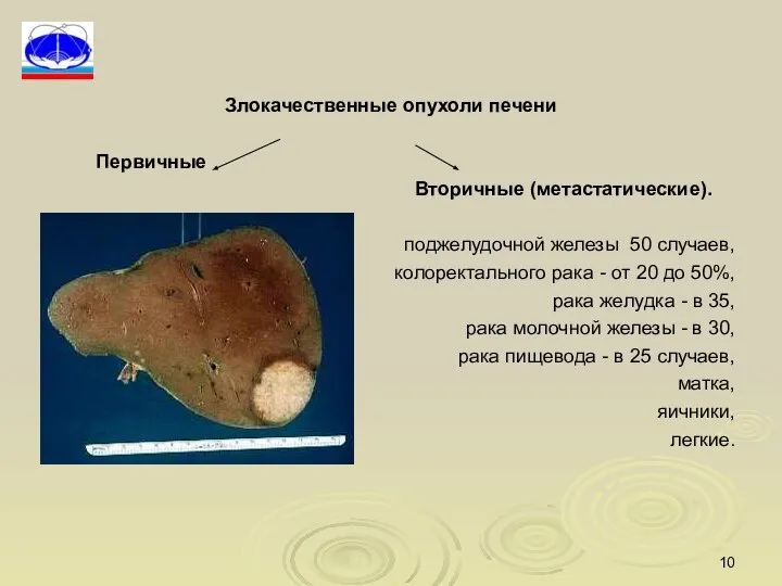 Злокачественные опухоли печени Первичные Вторичные (метастатические). поджелудочной железы 50 случаев, колоректального рака