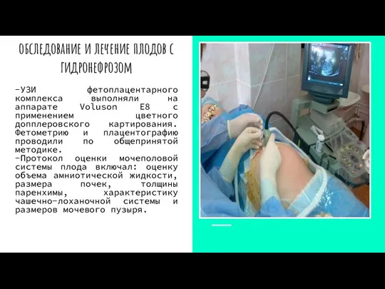 обследование и лечение плодов с гидронефрозом -УЗИ фетоплацентарного комплекса выполняли на аппарате