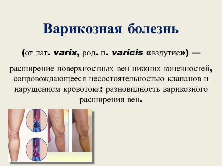 Варикозная болезнь (от лат. varix, род. п. varicis «вздутие») — расширение поверхностных