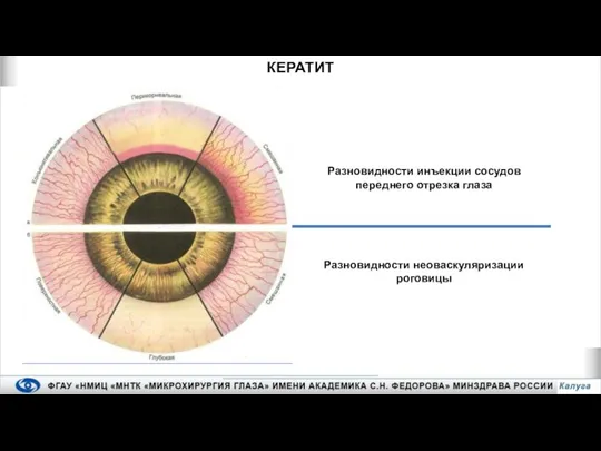 КЕРАТИТ Разновидности инъекции сосудов переднего отрезка глаза Разновидности неоваскуляризации роговицы