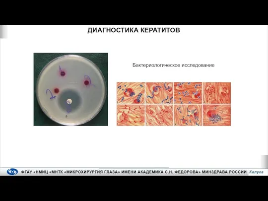Бактериологическое исследование ДИАГНОСТИКА КЕРАТИТОВ