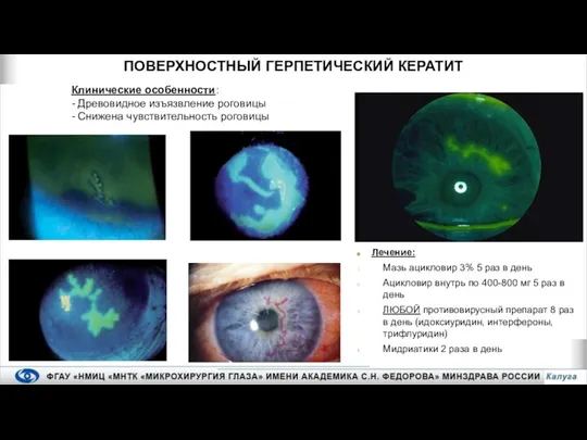 Клинические особенности: - Древовидное изъязвление роговицы - Снижена чувствительность роговицы ПОВЕРХНОСТНЫЙ ГЕРПЕТИЧЕСКИЙ
