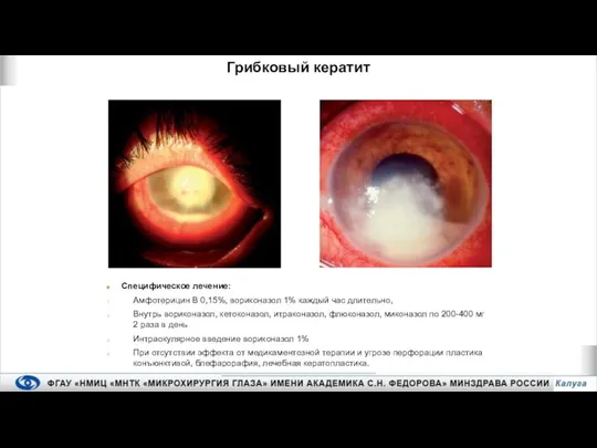 Специфическое лечение: Амфотерицин В 0,15%, вориконазол 1% каждый час длительно, Внутрь вориконазол,