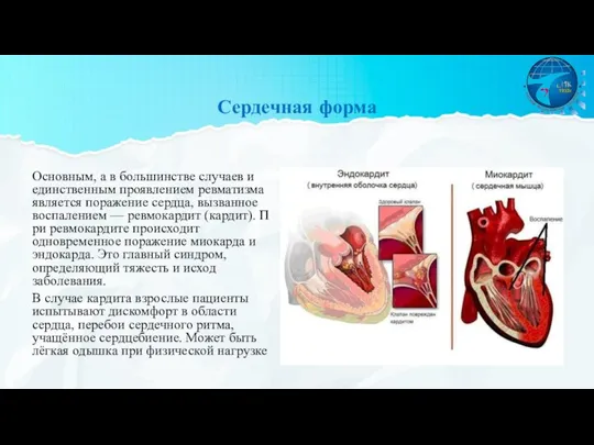 Сердечная форма Основным, а в большинстве случаев и единственным проявлением ревматизма является