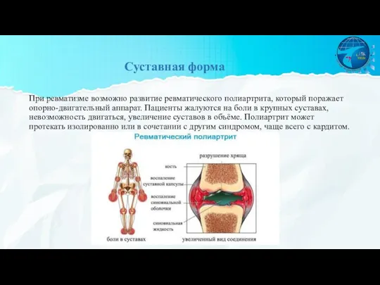 При ревматизме возможно развитие ревматического полиартрита, который поражает опорно-двигательный аппарат. Пациенты жалуются