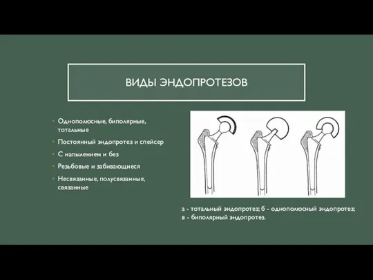 ВИДЫ ЭНДОПРОТЕЗОВ Однополюсные, биполярные, тотальные Постоянный эндопротез и спейсер С напылением и