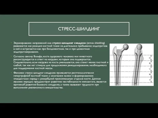 СТРЕСС-ШИЛДИНГ Экранирование напряжений или стресс-шилдинг синдром (stress shielding) развивается как реакция костной