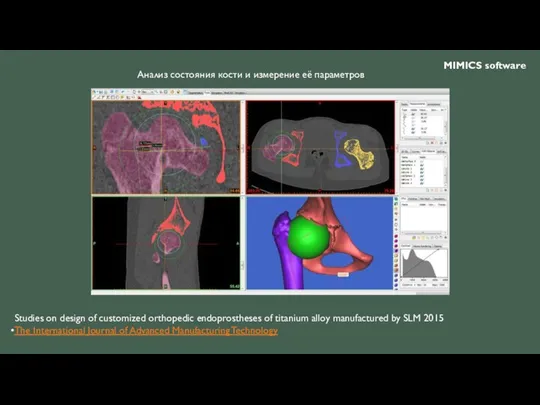 Studies on design of customized orthopedic endoprostheses of titanium alloy manufactured by