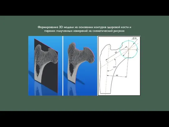 Формирование 3D модели на основании контуров здоровой кости и перенос полученных измерений на схематический рисунок