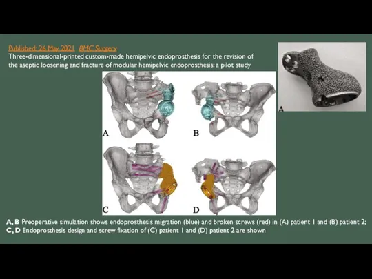 Published: 26 May 2021 BMC Surgery Three-dimensional-printed custom-made hemipelvic endoprosthesis for the