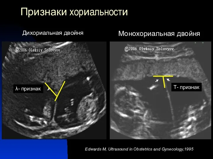 Признаки хориальности Дихориальная двойня Edwards M, Ultrasound in Obstetrics and Gynecology,1995 λ-