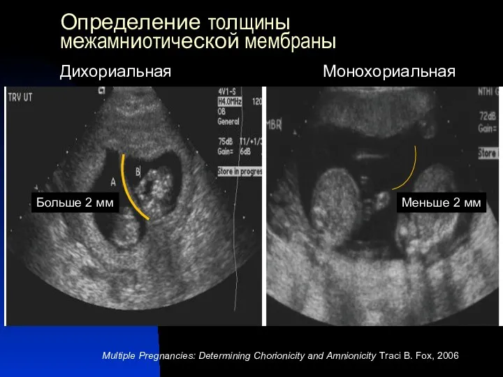 Определение толщины межамниотической мембраны Multiple Pregnancies: Determining Chorionicity and Amnionicity Traci B.