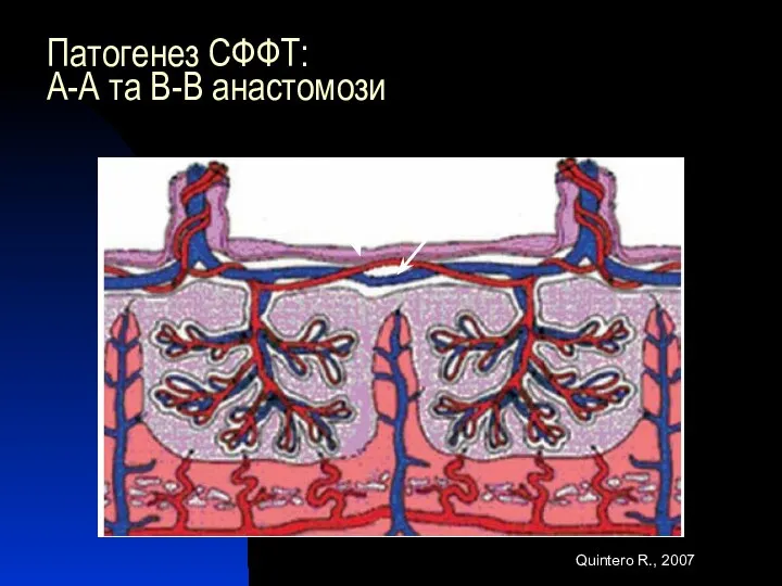 Патогенез СФФТ: А-А та В-В анастомози А-А В-В Quintero R., 2007