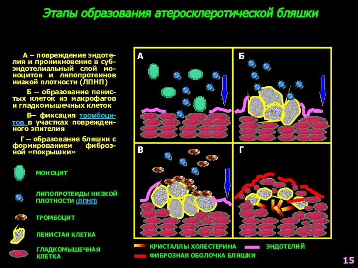 А Б В Г Этапы образования атеросклеротической бляшки А – повреждение эндоте-лия