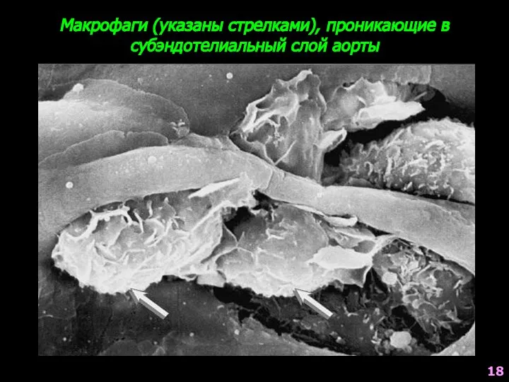 Макрофаги (указаны стрелками), проникающие в субэндотелиальный слой аорты 18