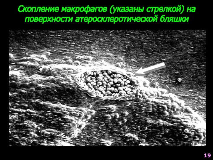 Скопление макрофагов (указаны стрелкой) на поверхности атеросклеротической бляшки 19