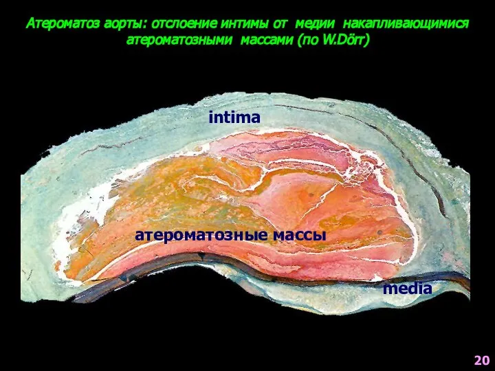 Атероматоз аорты: отслоение интимы от медии накапливающимися атероматозными массами (по W.Dörr) intima media атероматозные массы 20