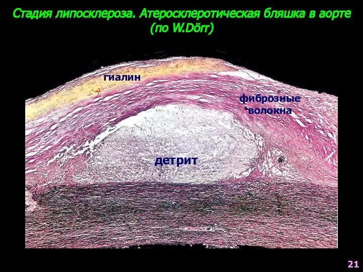 Стадия липосклероза. Атеросклеротическая бляшка в аорте (по W.Dörr) детрит фиброзные волокна гиалин 21
