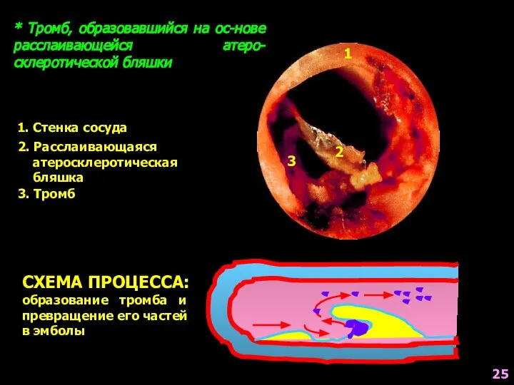 * Тромб, образовавшийся на ос-нове расслаивающейся атеро-склеротической бляшки СХЕМА ПРОЦЕССА: образование тромба