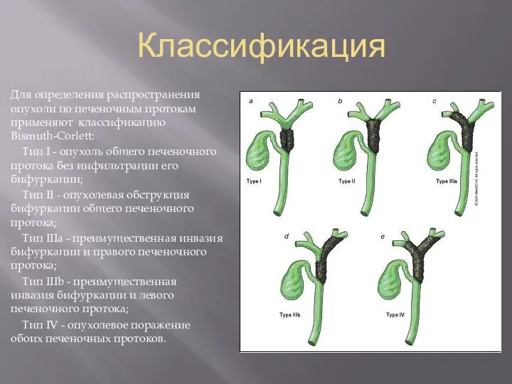 Классификация Для определения распространения опухоли по печеночным протокам применяют классификацию Bismuth-Corlett: Тип