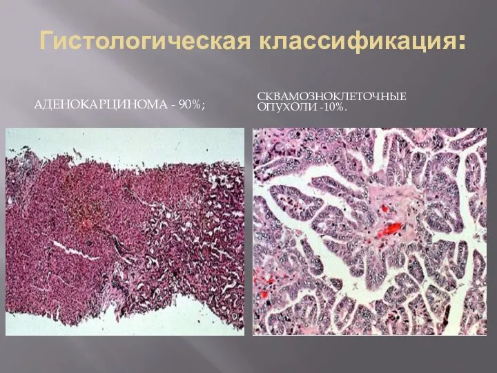 Гистологическая классификация: АДЕНОКАРЦИНОМА - 90%; СКВАМОЗНОКЛЕТОЧНЫЕ ОПУХОЛИ -10%.