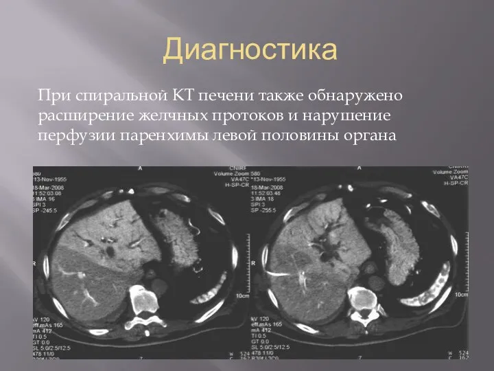 Диагностика При спиральной КТ печени также обнаружено расширение желчных протоков и нарушение