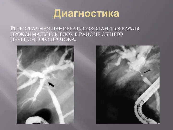 Диагностика РЕТРОГРАДНАЯ ПАНКРЕАТИКОХОЛАНГИОГРАФИЯ, ПРОКСИМАЛЬНЫЙ БЛОК В РАЙОНЕ ОБЩЕГО ПЕЧЕНОЧНОГО ПРОТОКА.