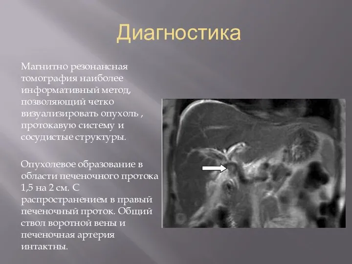 Диагностика Магнитно резонансная томография наиболее информативный метод, позволяющий четко визуализировать опухоль ,