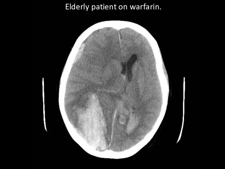 Elderly patient on warfarin.