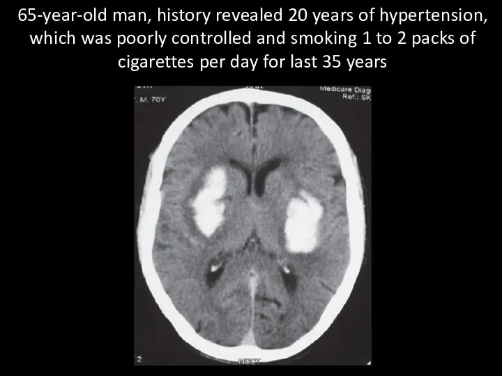 65-year-old man, history revealed 20 years of hypertension, which was poorly controlled