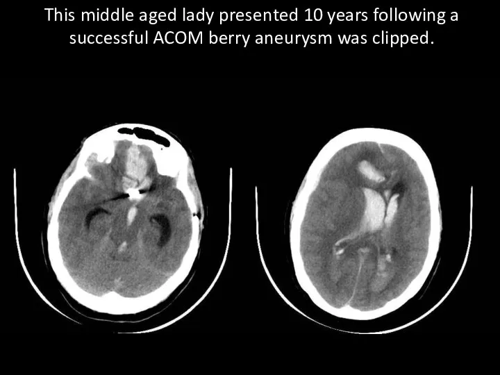 This middle aged lady presented 10 years following a successful ACOM berry aneurysm was clipped.