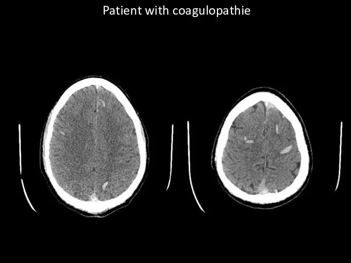 Patient with coagulopathie