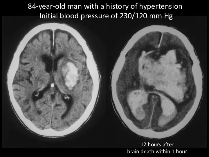 84-year-old man with a history of hypertension Initial blood pressure of 230/120