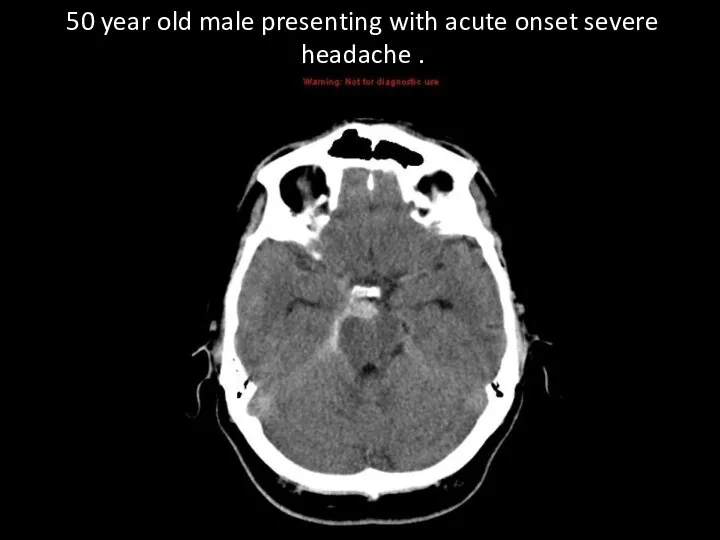 50 year old male presenting with acute onset severe headache .