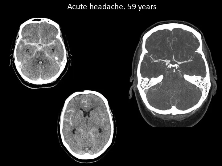 Acute headache. 59 years