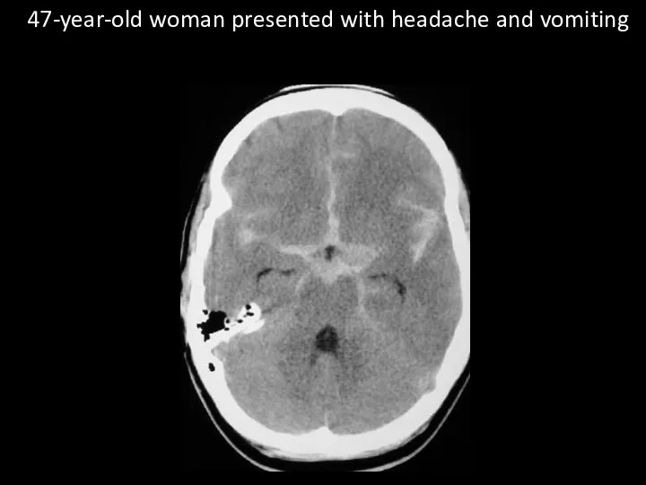 47-year-old woman presented with headache and vomiting