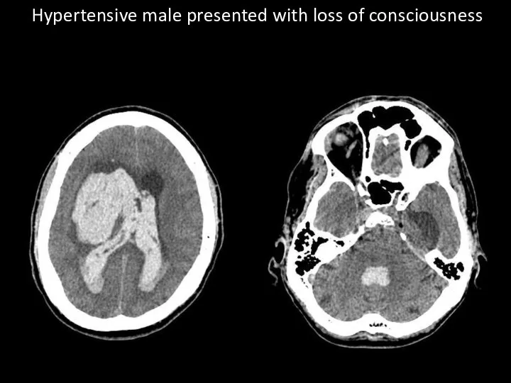 Hypertensive male presented with loss of consciousness